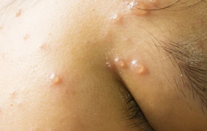 会留疤吗?打了水痘疫苗还会得水痘吗?