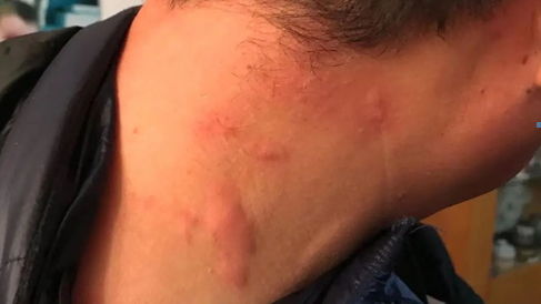 一觉醒来一脖子包又痒又肿 医生:你这是冷空气过敏