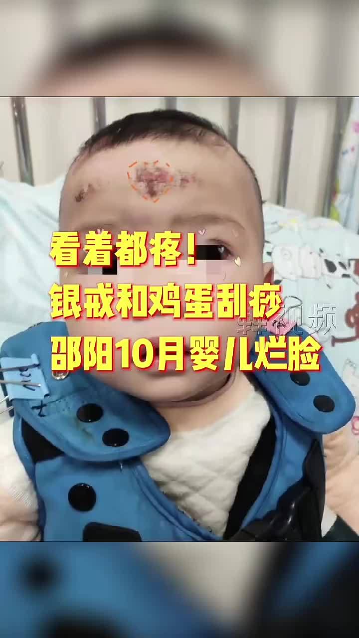 看着都疼外婆给10个宝宝用银戒指刮痧导致孩子脸部溃烂