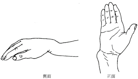 章水均主任表示,手腕骨折按照受伤机制的不同可分为伸直型骨折和屈曲